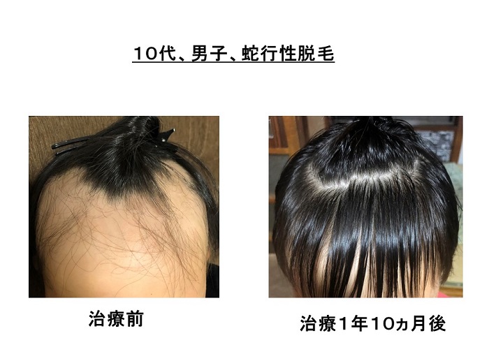 円形脱毛症　病院